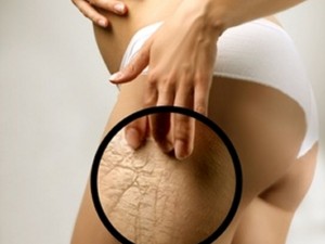 Rimedi Contro la Cellulite: Via la buccia d’ arancia